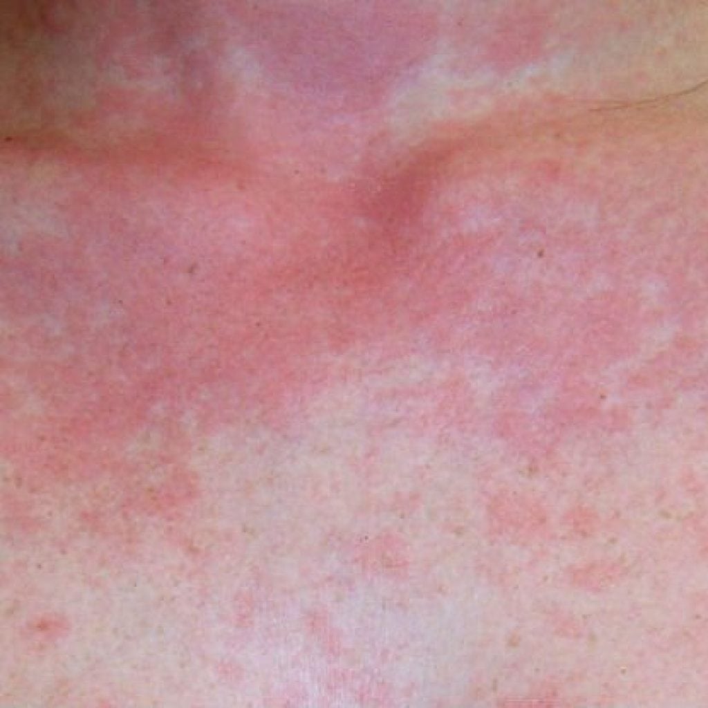 Allergy to the sun: symptoms, photo treatment in adults, children