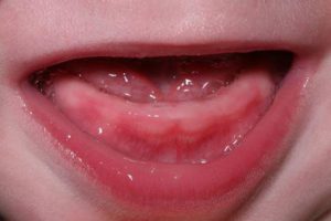 Dentes estão sendo cortados