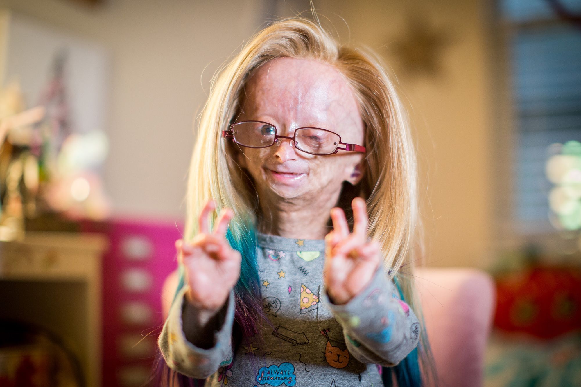 Progeria (vroegtijdig verouderingssyndroom): wat het is, symptomen, oorzaken, behandeling