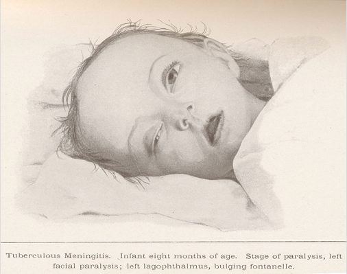 Tuberculeuze meningitis: oorzaken, symptomen, behandeling, prognose