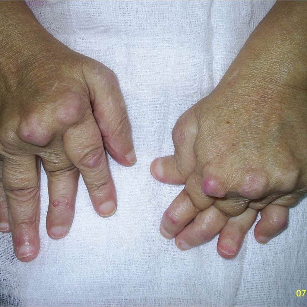 Rheumatoid arthritis: mi ez, tünetek, hogyan kell kezelni, fotó