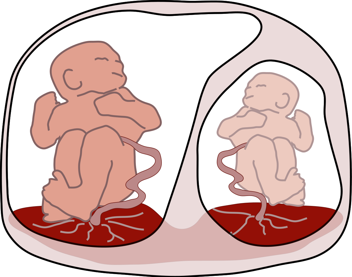 Feto-fetales Transfusionssyndrom: Was ist das, Ursachen, Symptome, Behandlung, Prognose