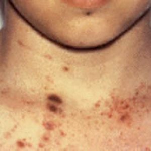 Blødende diatese hos børn: symptomer, diagnose og behandling