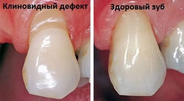 Wigvormig defect van tanden: wat is het, oorzaken, symptomen, behandeling, preventie