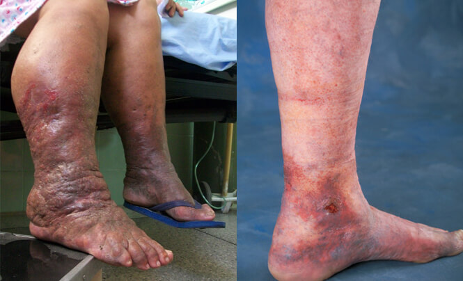 Tiefe Venenthrombose: Was ist das, Symptome, Ursachen, Behandlung, Prognose
