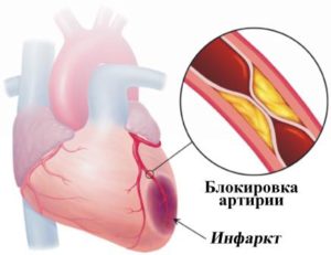 Ischemia cardiaca