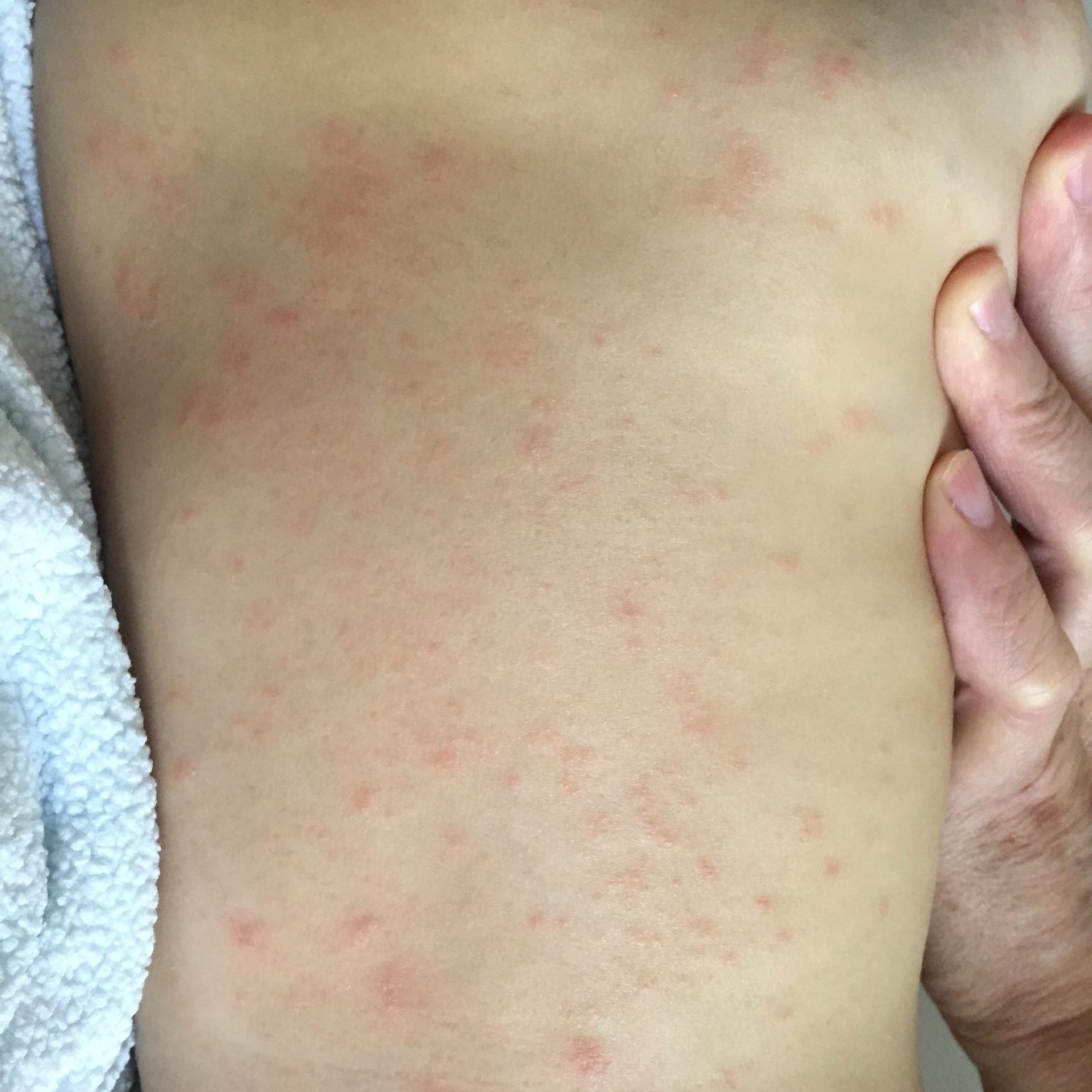 Allergia alla polvere: cause, sintomi, trattamento per bambini, adulti