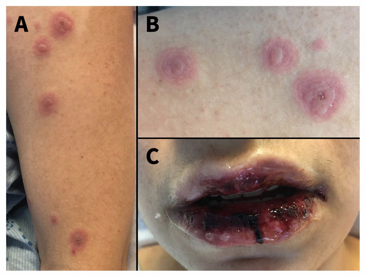 Erythema multiforme: Was ist das, Symptome, Ursachen, Behandlung, Prognose