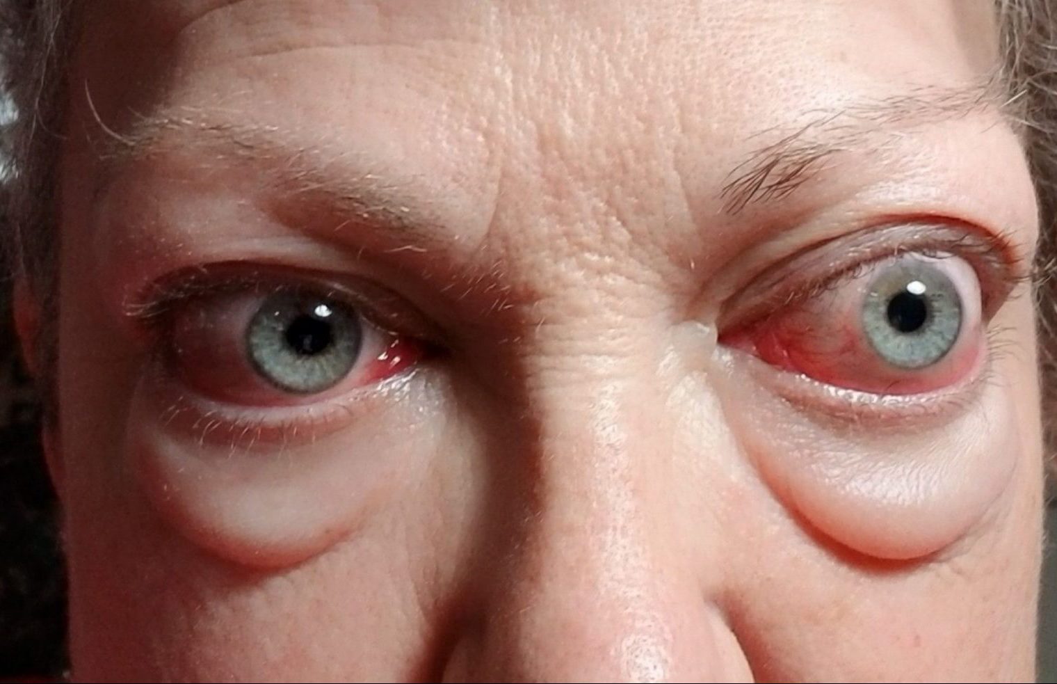 Morbus Basedow: Was ist das, Symptome, Behandlung, Prognose