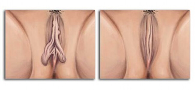 Hypertrophie der inneren Schamlippen und Labiaplasty als eine Möglichkeit der Korrektur