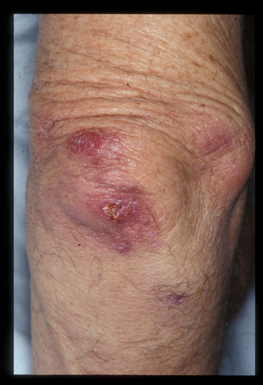 Churg-Strauss-Syndrom: Was ist das, Symptome, Behandlung, Prognose