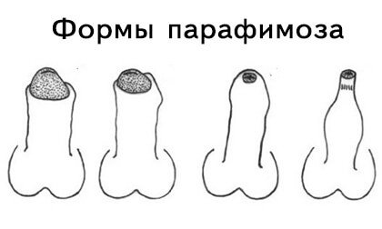 Paraphimosis - oireet, diagnoosi, hoito ja ennaltaehkäisy