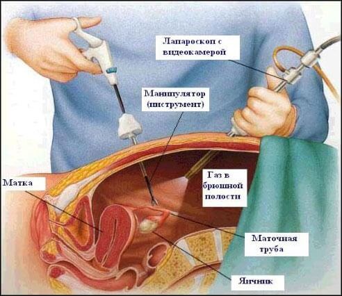 Laparoskopi: hvad det er, de fordele og ulemper ved laparoskopi abdominale organer