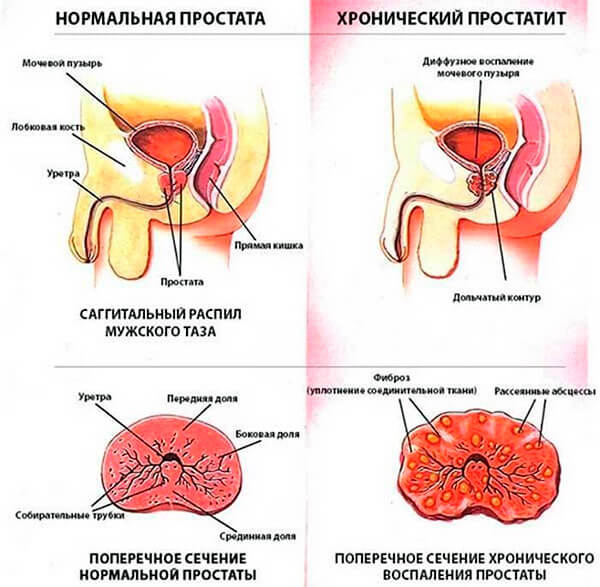 Krooninen eturauhastulehdus: oireet, syyt, diagnostiset menetelmät ja hoitoa, ennustaa urologian