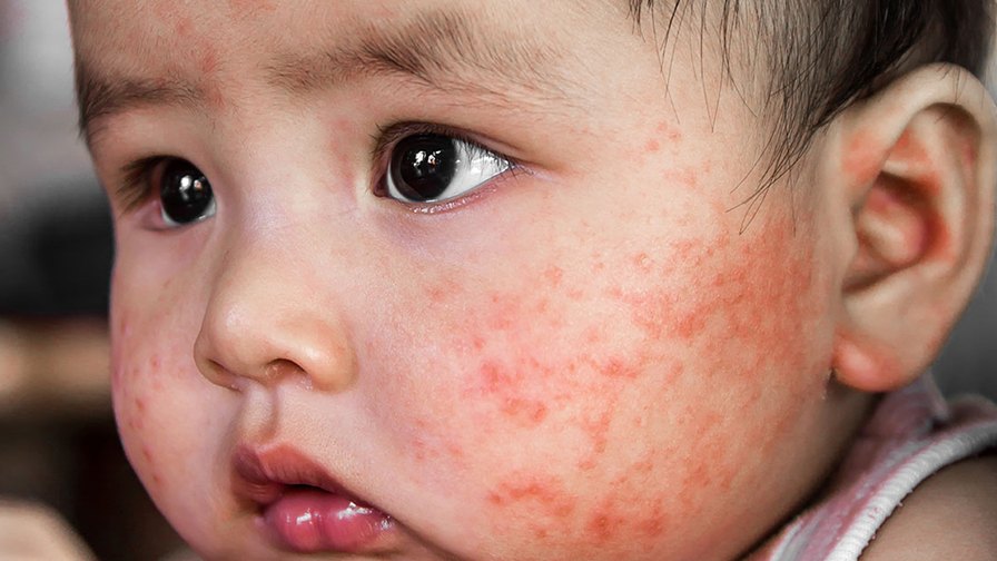 Atopische dermatitis bij kinderen: symptomen (foto), behandeling, medicijnen