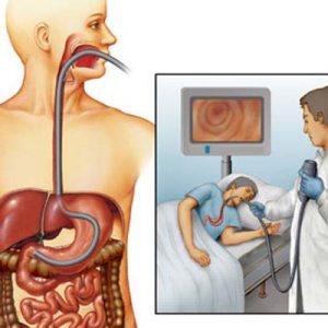 Endoscopie GI: œsophagoscopie, gastroscopie, duodénoscopie, l'endoscopie intestinale