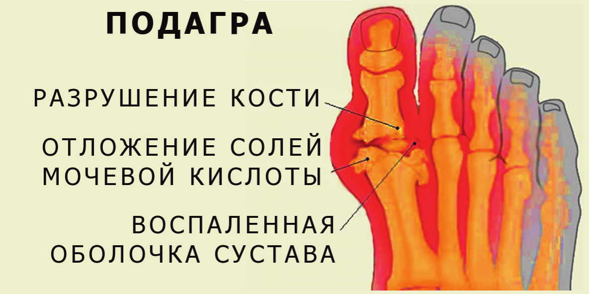 Облици артритиса и лечење болести