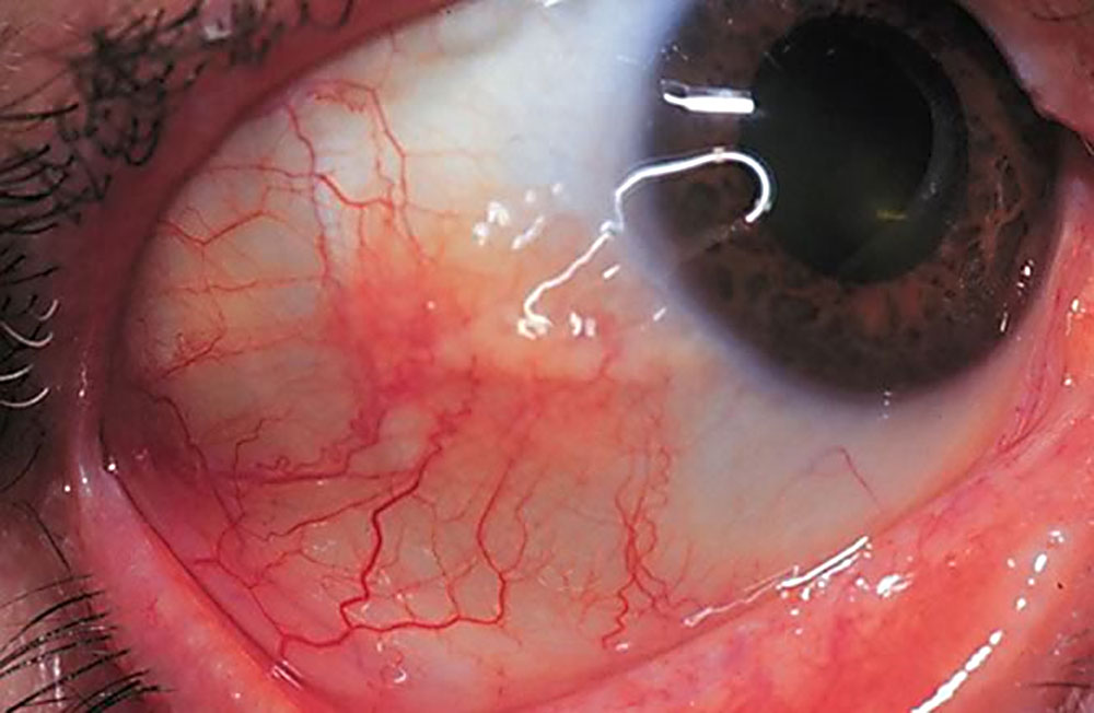 Bruised eyes: symptoms and treatment