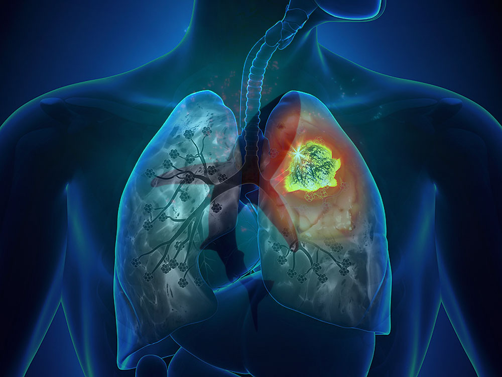 Sick sinus syndrome: what is it, symptoms, treatment, prognosis