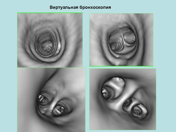 Bronchoscopie: Comment faire une endoscopie des voies respiratoires, la préparation de la procédure