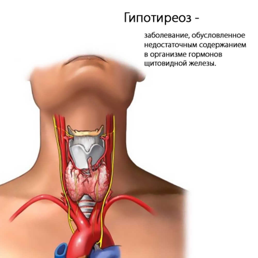 Diagnostic de la thyroïde hypothyroïdie