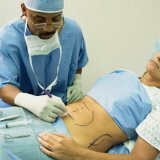 Plastische Chirurgie: Abdominoplastik