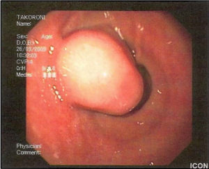Neoplasma im Magen