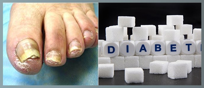 Neglesvamp ved diabetes mellitus: behandling, kursusfunktioner