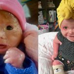 Harlekin-Ichthyose: Was ist das, Fotos, Symptome, Behandlung, Prognose