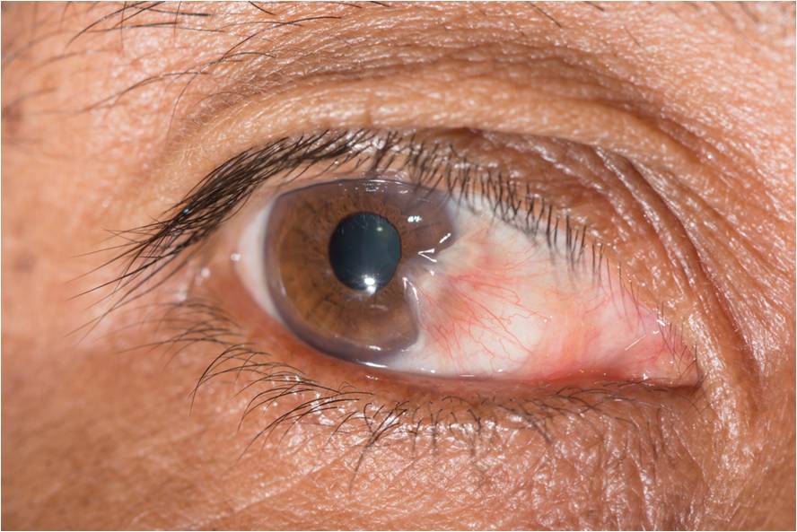 Pterigium di mata: apa itu, penyebab, gejala, foto, pengobatan