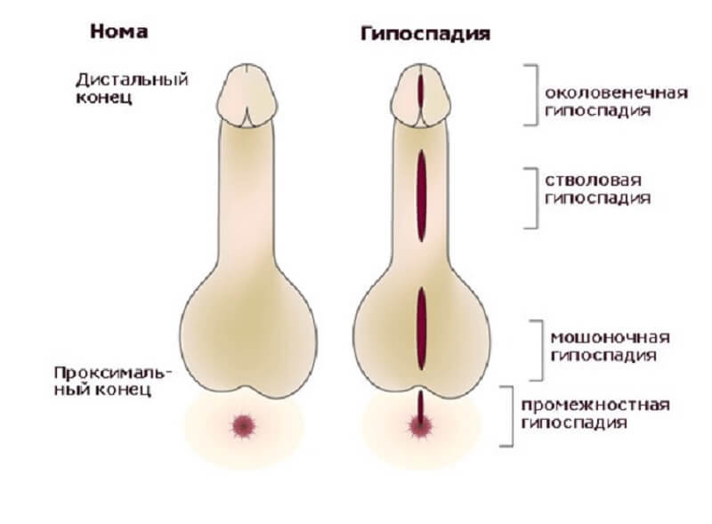 Stammform der Hypospadie und Merkmale ihrer Behandlung