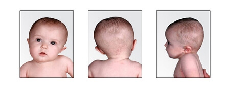 Torticollis bei Säuglingen: Symptome, Behandlung, Vorbeugung