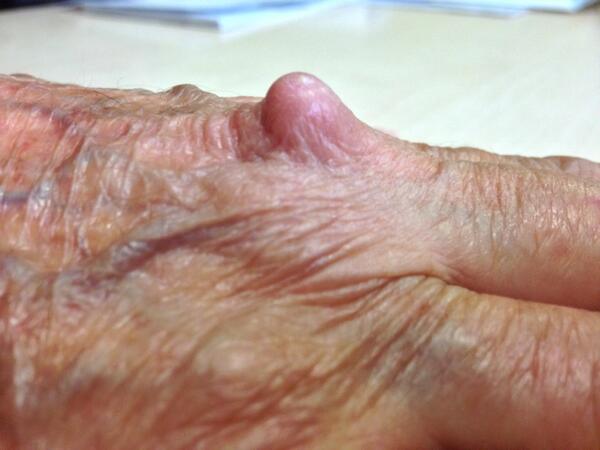 Felty-Syndrom: Was ist das, Symptome, Behandlung, Prognose?