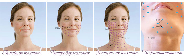 Mesotherapie Gesicht, Körper und Kopfhaut: Indikationen, Kontraindikationen, mögliche Wirkung
