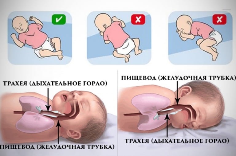 Syndrom náhlého úmrtí kojenců (SIDS): příčiny, příznaky