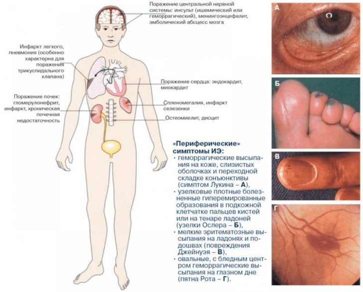 Endokarditida: příznaky a léčba