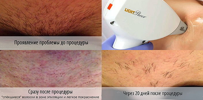 Epilation und Laser-Haarentfernung: es ist besser