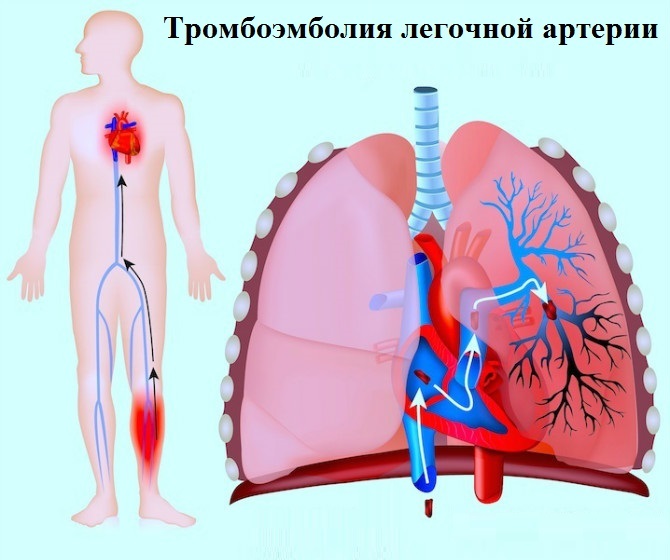Pulmonell hjärtsjukdomar: diagnos och behandling