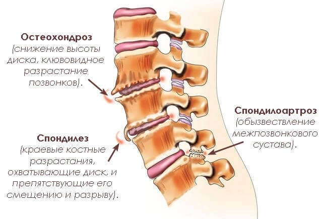 Spondylose der Lumbal-Sakralwirbelsäule