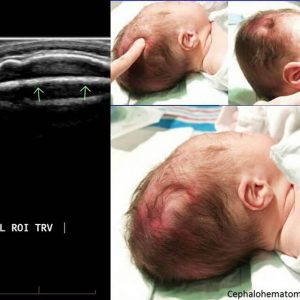 Cephalohematoma bei Neugeborenen: Wirkungen, Behandlung und Beseitigung