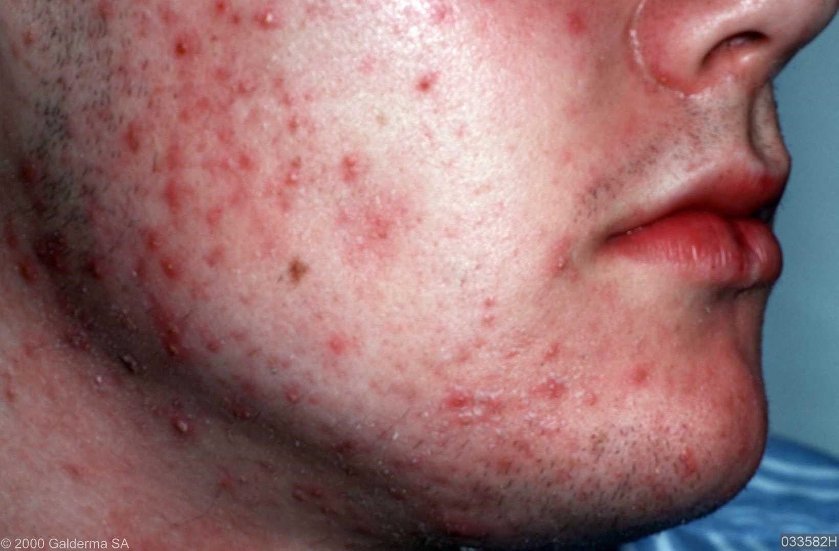 Akne vulgaris: Was ist das, Ursachen, Symptome, Behandlung, Prognose