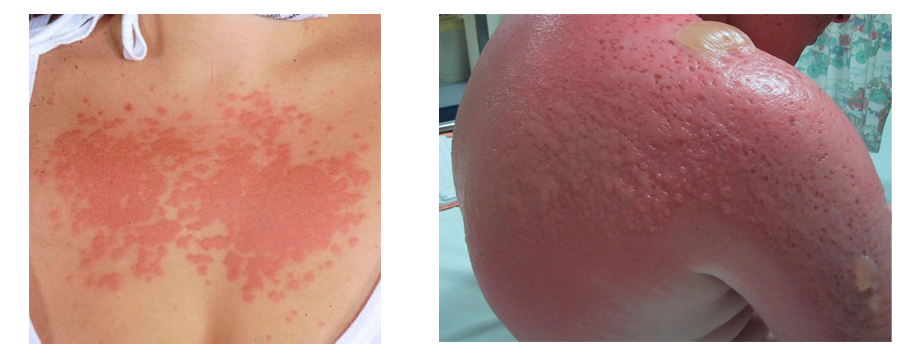 Allergi over for solen - fotodermatit