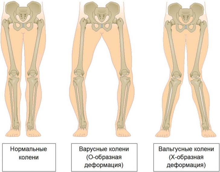 Die Krümmung des Unterschenkels bei einem Kind und einem Erwachsenen: Ursachen Pathologie und Korrekturverfahren