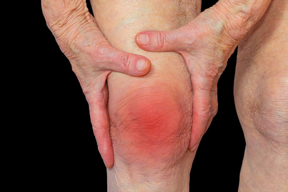 Arthritis: Was ist das, Ursachen, Symptome, Behandlung, Prognose