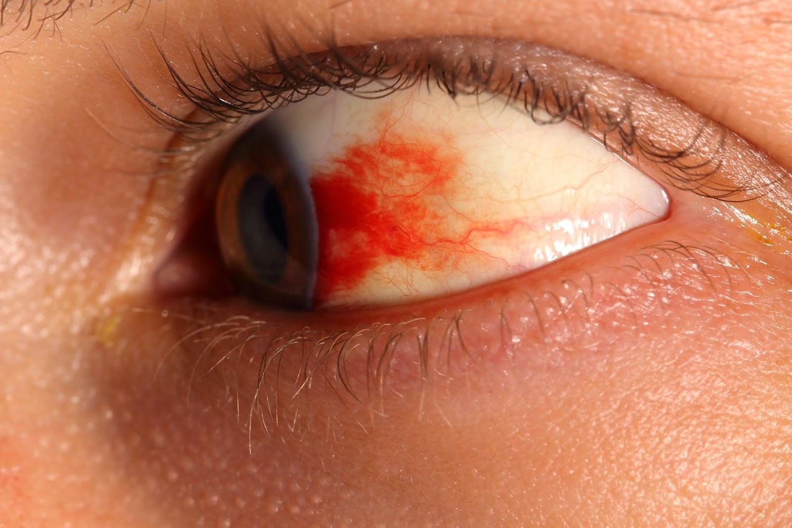 Diabetična retinopatija: kaj je to, simptomi, zdravljenje