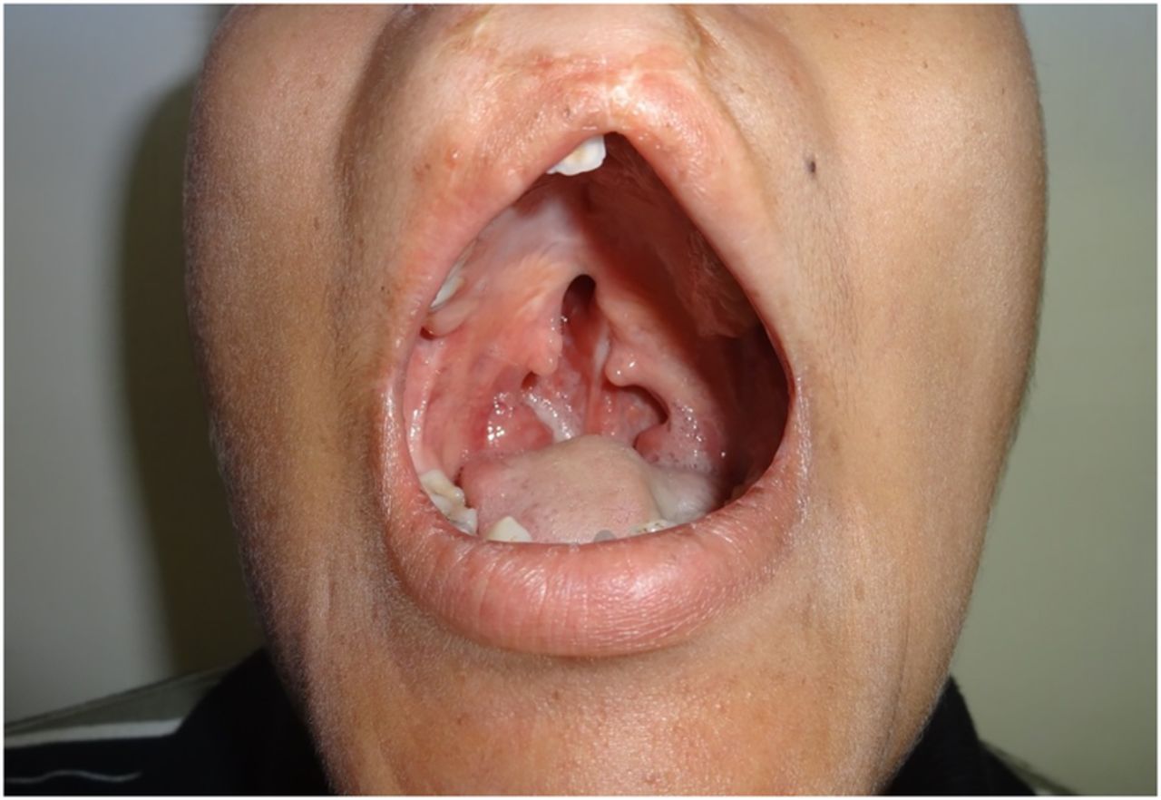 Kallman-Syndrom: Was ist das, Symptome, Behandlung, Prognose