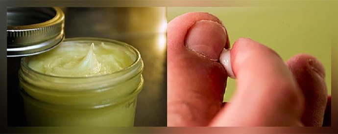 Liječenje gljivica na noktima praškom za pranje: recepti, recenzije