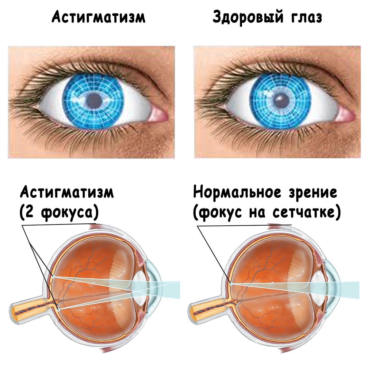 Hiperopični astigmatizam: što je to, simptomi, liječenje