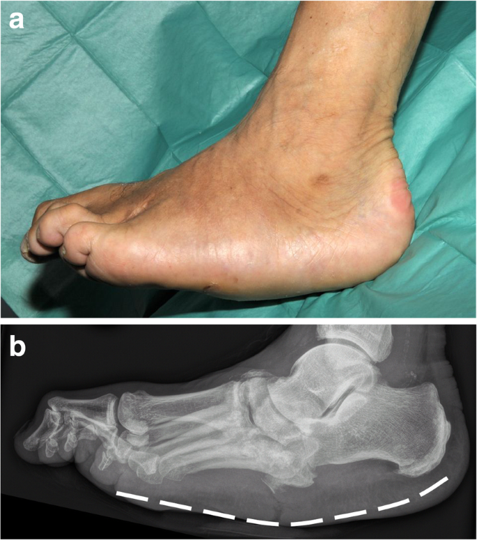 Charcot-Fuß: Was ist das, Ursachen, Symptome, Behandlung, Prognose