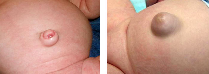 Nabelhernie bei Kindern: Symptome, Behandlung, Indikationen für die Chirurgie